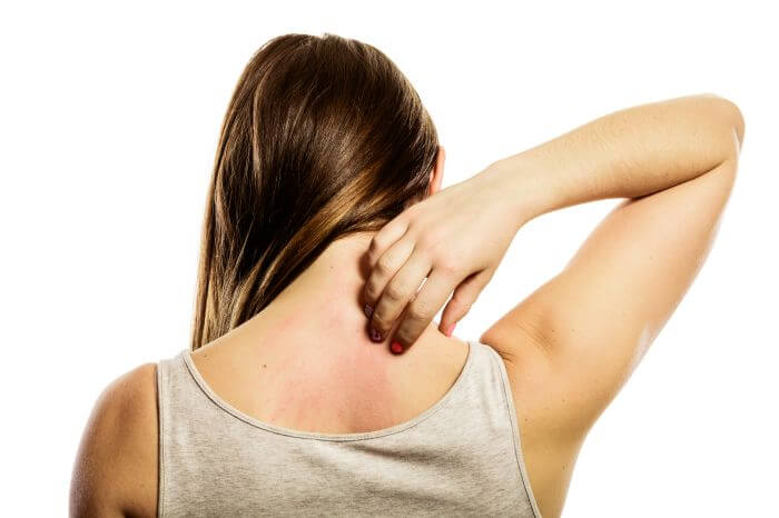 Woman with itchy, unhealthy red rash on her skin scratching her back